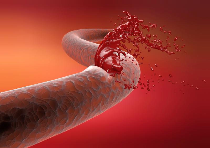 Bleeding risk high for percutaneous coronary intervention patients