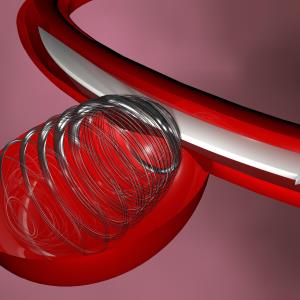 Aneurysm plugging device proven safe, effective in real-world study