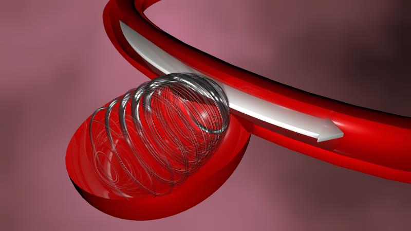 Aneurysm plugging device proven safe, effective in real-world study