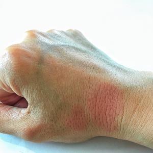 SLE rash treatment better with GC plus hydroxychloroquine combo vs GC monotherapy