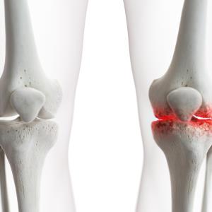 Antihistamines potentially beneficial for knee OA