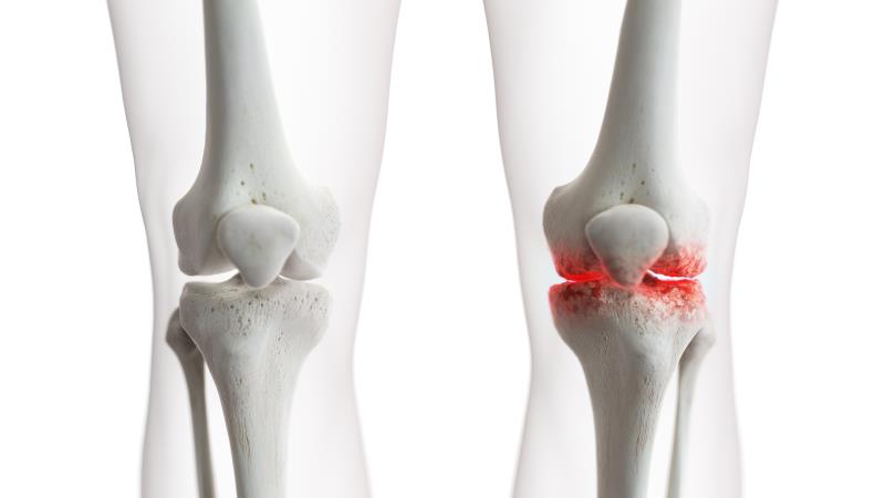 Antihistamines potentially beneficial for knee OA