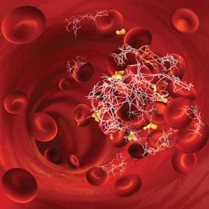 Antithrombotic agents avert death in acute upper GI bleeding