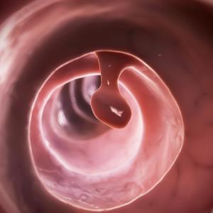 Water exchange reduces right colon adenoma, serrated polyp miss rates