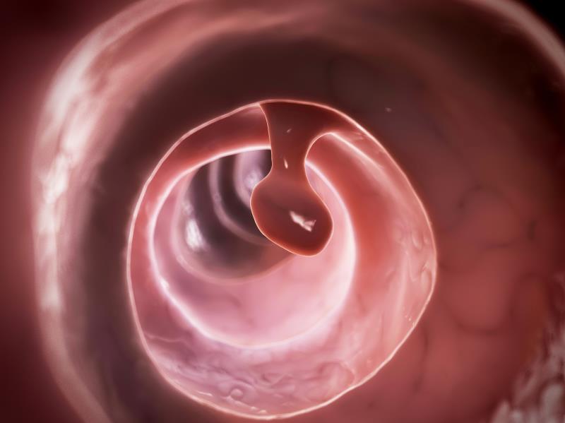 Water exchange reduces right colon adenoma, serrated polyp miss rates