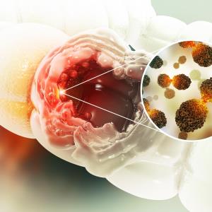 Any upside to frontline mFOLFOXIRI-panitumumab in mCRC?