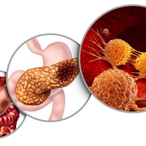 Nab-paclitaxel/gemcitabine combo boosts OS in resected pancreatic cancer