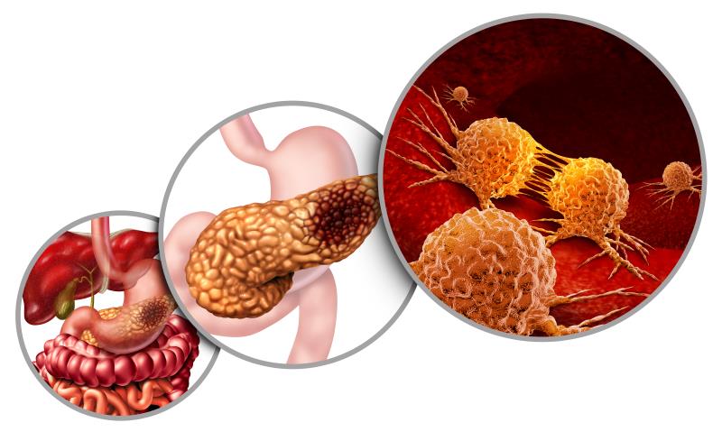 Nab-paclitaxel/gemcitabine combo boosts OS in resected pancreatic cancer