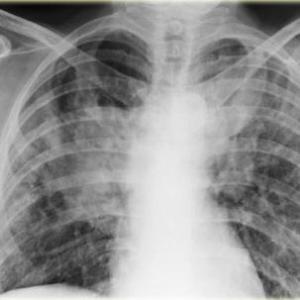 Hint of benefit with antifibrotic treatment seen for interstitial lung disease