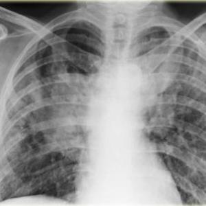 Excess fat a modifiable risk factor for interstitial lung disease