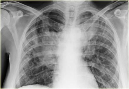 Older age and female sex are some of the factors associated with early-onset interstitial lung disease (ILD) in <a href="http