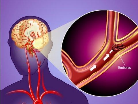 High admission GPR worsens death risk in ischaemic stroke