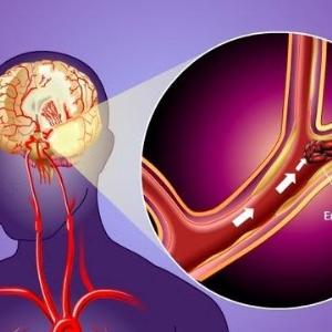 High admission GPR worsens death risk in ischaemic stroke