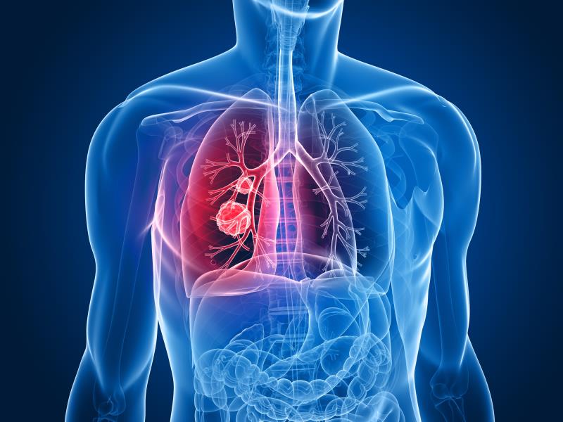 Adding anlotinib to gefitinib improves PFS in treatment-naïve Chinese patients with EGFRmut NSCLC