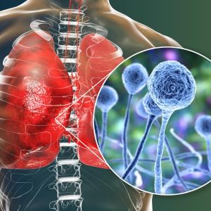 Approaches to diagnosis and management of invasive aspergillosis and mucormycosis