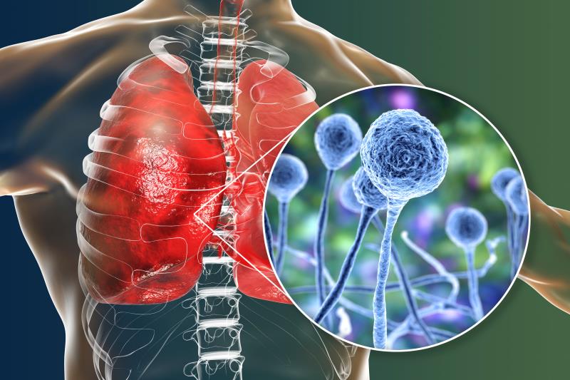 Approaches to diagnosis and management of invasive aspergillosis and mucormycosis