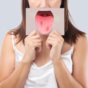 Roflumilast holds therapeutic potential for severe recurrent aphthous stomatitis