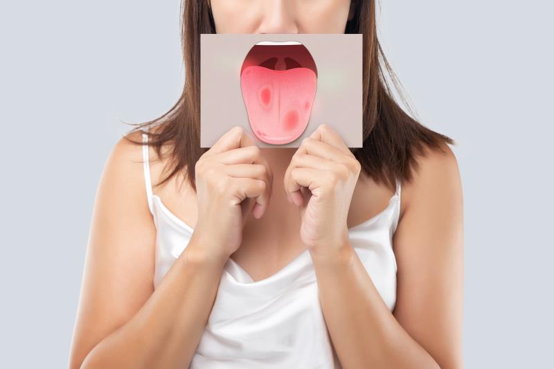 Roflumilast holds therapeutic potential for severe recurrent aphthous stomatitis