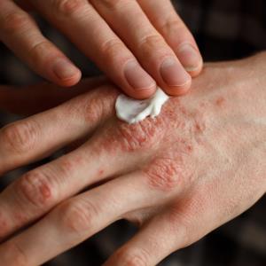 Acitretin, apremilast, methotrexate safe, effective for ICI-mediated psoriasis