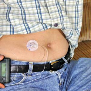 Artificial pancreas yields good results in type 2 diabetes patients