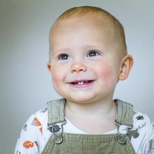 As-needed ruxolitinib in children with AD: Disease control stable through 52 weeks