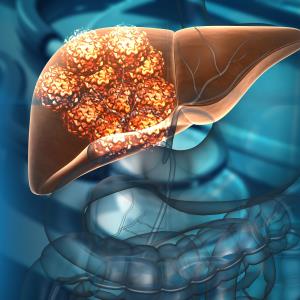 Lenvatinib-TACE combo a new first-line treatment alternative for advanced liver cancer?