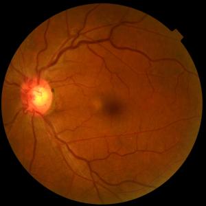 Retinal neuronal, axonal layers thinner in diabetic eyes without retinopathy