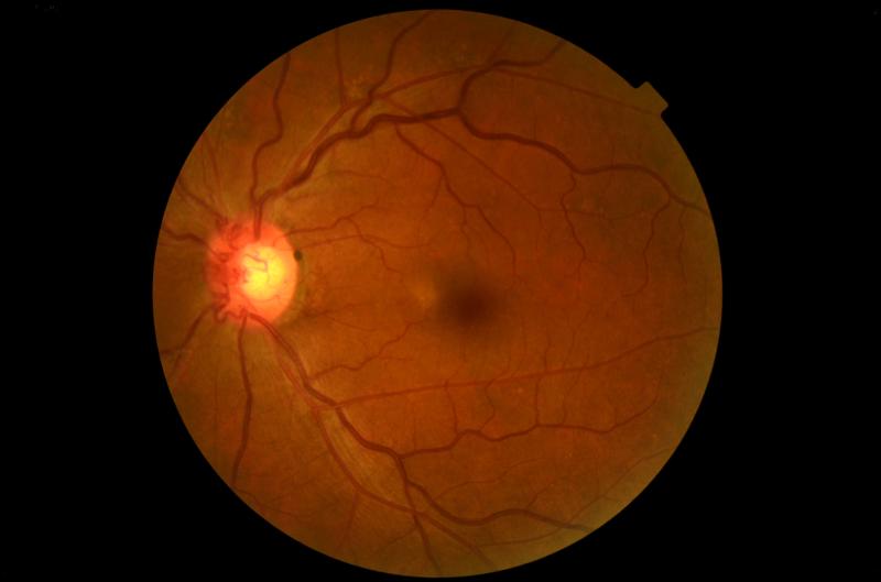 Retinal neuronal, axonal layers thinner in diabetic eyes without retinopathy