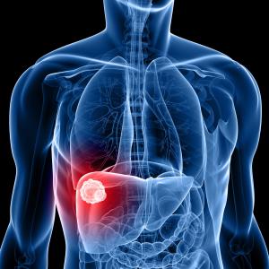 Hepatic resection offers decent chances of curing hepatocellular carcinoma