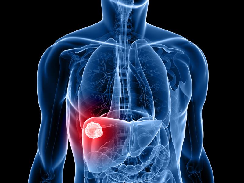 Hepatic resection offers decent chances of curing hepatocellular carcinoma