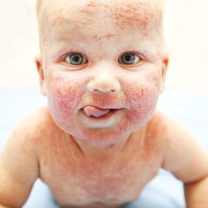 Atopic dermatitis poses mental health threat to kids