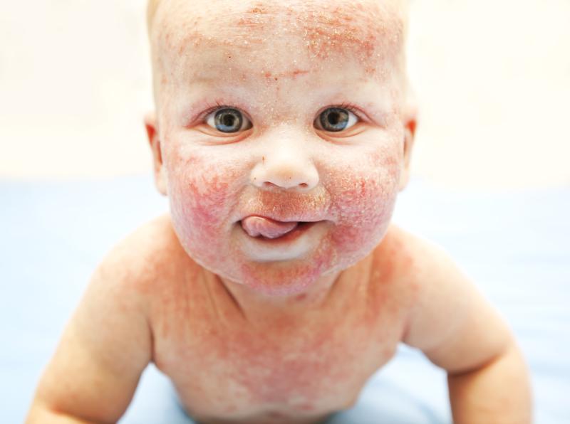 Atopic dermatitis poses mental health threat to kids