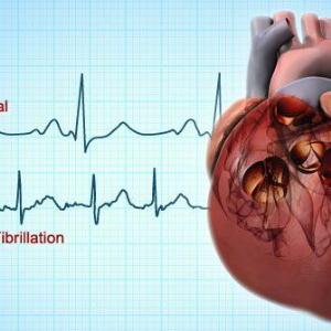 Left atrial appendage closure noninferior to DOACs in preventing AF-related CV, neurological events