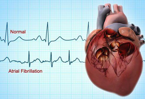 Left atrial appendage closure noninferior to DOACs in preventing AF-related CV, neurological events