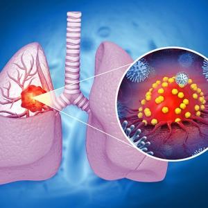 Aumolertinib ups PFS in EGFR-mutated NSCLC