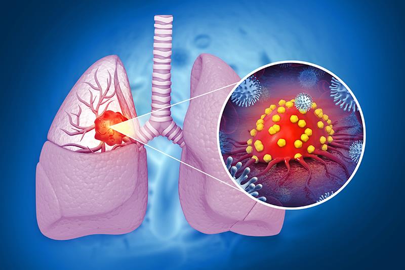 Aumolertinib ups PFS in EGFR-mutated NSCLC
