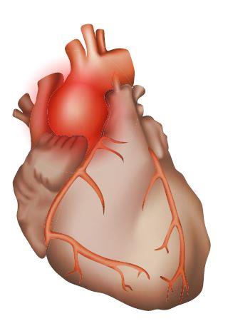 Aortic Aneurysm: โรคหลอดเลือดแดงใหญ่โป่งพอง