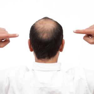 Male pattern baldness not indicative of prostate cancer risk, progression