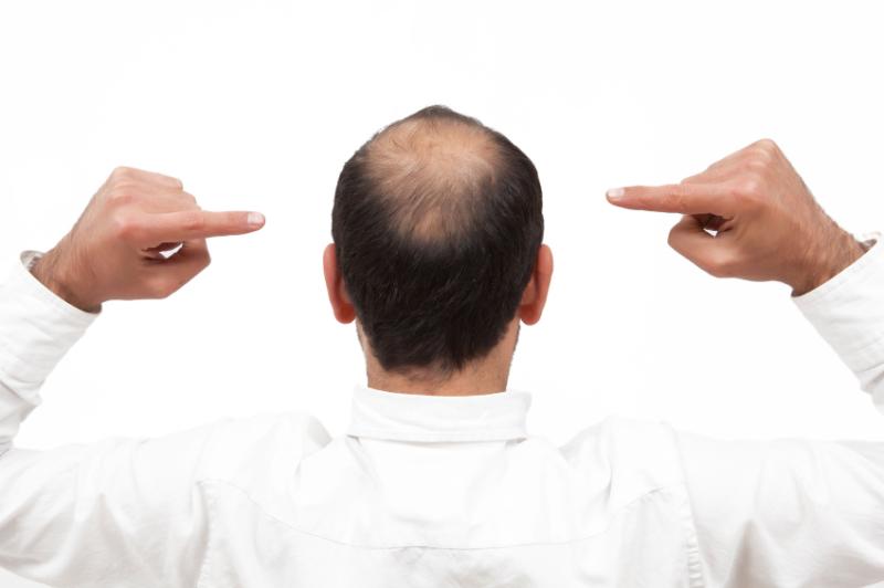 Male pattern baldness not indicative of prostate cancer risk, progression