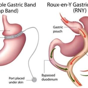 Bariatric surgery improves BP control in obese, hypertensive patients