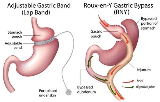 Bariatric surgery improves BP control in obese, hypertensive patients