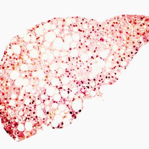 New NAFLD, fibrosis progression tied to increased CKD risk