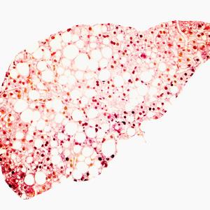 Thyroid hormone sensitivity tied to advanced liver fibrosis in NAFLD