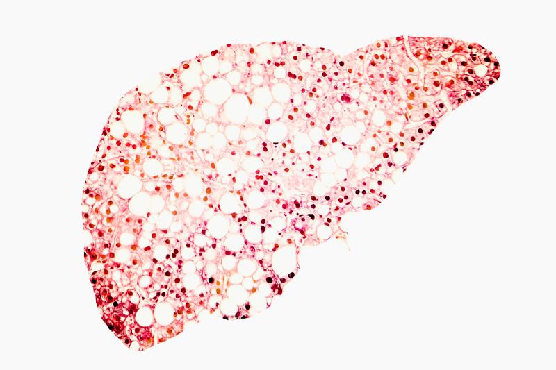 Thyroid hormone sensitivity tied to advanced liver fibrosis in NAFLD