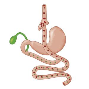 Bariatric surgery provides cardioprotection in patients with severe obesity, NAFLD