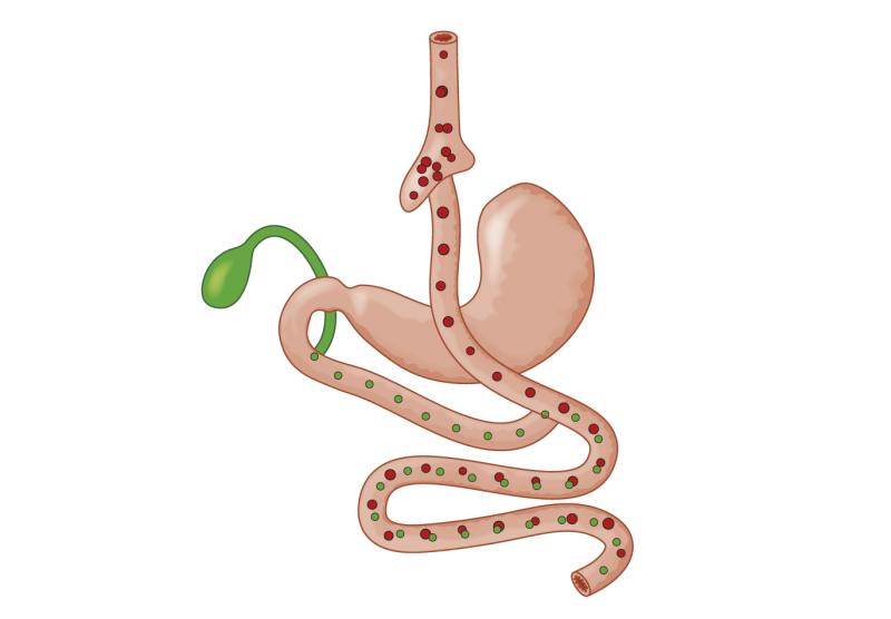 Bariatric surgery provides cardioprotection in patients with severe obesity, NAFLD