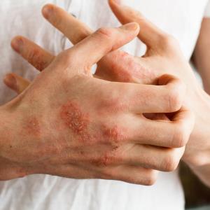 Crisaborole suppresses skin inflammation in atopic dermatitis