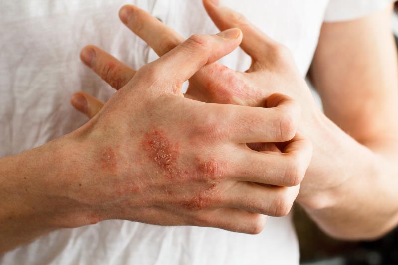 Crisaborole suppresses skin inflammation in atopic dermatitis