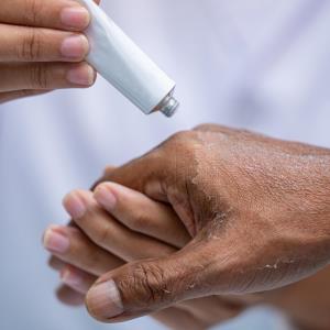 Baricitinib safe, effective in moderate-to-severe atopic dermatitis