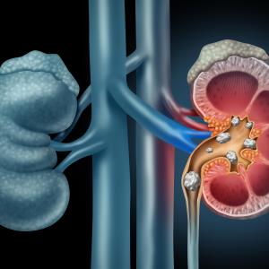 Secondary kidney stones: to remove or not?